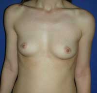 Асимметрия груди